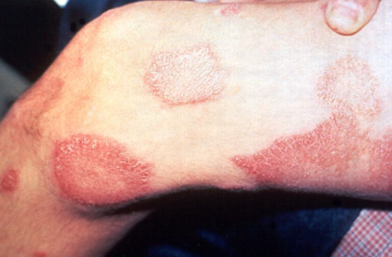 Leprosy_thigh_demarcated_cutaneous_lesions