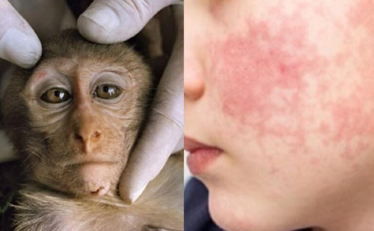 sintomas-viruela-del-mono-chapintv